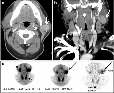 Fig. 17. Ectopic thyroid on the left parotid gland with a palpable left parotid mass in a 69-year-old male patient. a, b Axial and coronal enhanced neck CT scan demonstrates well-defined homogeneous enhancing mass (white arrows) within the left parotid gland with preserved surrounding fat planes. It also shows a normal thyroid in normal position in the lower neck. c Image taken 20 minutes after 5 mCi injected Tc99m-Pertechnetate shows normal thyroid uptake of tracer and physiological uptake in the salivary glands (short black arrow). There is a distinct focus of abnormal tracer accumulation in the left parotid/submandibular region. Patient was given lemon juice with evident normal washout from the salivary glands and relative retention by this abnormal focus (long black arrow).