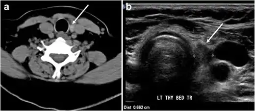 Fig. 7. A 51-year-old female patient post total thyroidectomy for PTC with elevated thyroglobulin measurement. an Axial non-enhanced CT scan of the neck at the level of the thyroid bed demonstrates a well-defined, rounded, homogenously dense soft tissue situated between the trachea and left internal jugular vein (white arrow). b Transverse ultrasound image of the neck demonstrates a well-defined, homogeneous, hypoechoic soft tissue nodule measuring 6 mm (white arrow) with no detected micro-calcifications. Biopsy showed a predominantly residual normal thyroid tissue with micro-foci of PTC.