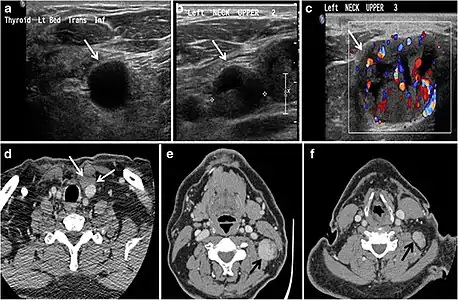 Fig. 9. A 58-year-old male patient with persistence PTC at thyroid bed with hypervascular nodal metastasis. a–c Transverse greyscale and colour Doppler neck ultrasound demonstrate hypoehoic soft tissue in the left thyroid bed (white arrow in a). There are a heterogeneous enlarged lymph nodes at level 2 and 3 with markedly increased vascularity (white arrow in b and c). d–f Enhanced axial CT images of the neck demonstrate a 2.7 × 1.4 cm hypodense soft tissue lesion anterior to the left carotid sheath (white arrow). There are left-sided enhancing abnormal and enlarged lymph nodes at cervical level 2 and 3 (black arrows).